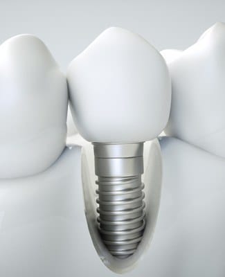 single dental implant in jawbone