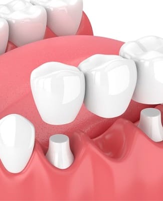 A diagram of a dental bridge