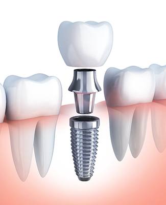 diagram of dental implant in Federal Way, abutment, and crown 