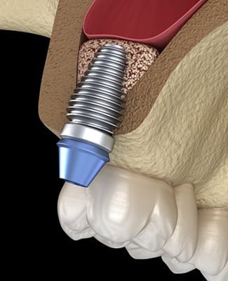 dental implant placed in upper jaw