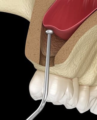 sinus lift procedure 