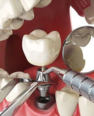 dental instruments placing a dental implant