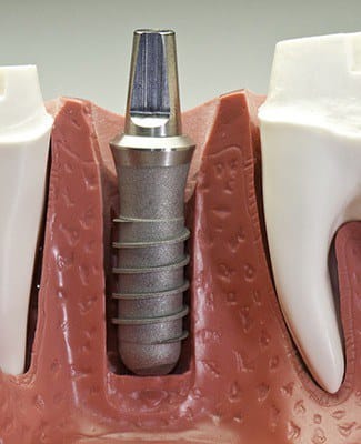 dental implant post in a model of the jaw 