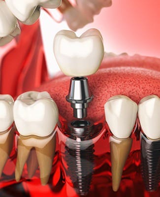 dental implant, abutment, and crown being placed in the mouth