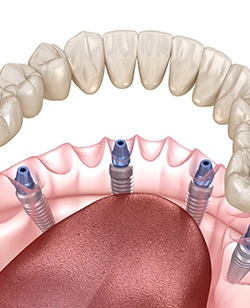 Implant dentures in Federal Way