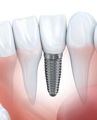 Single tooth dental implant, part of full mouth restoration