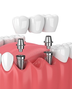 3D illustration of dental implants, abutments, and a dental bridge