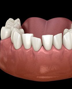 a 3D illustration of crowded teeth