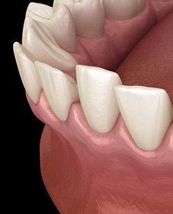 a 3D depiction of gaps between teeth