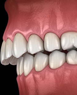 a 3D illustration of an overbite