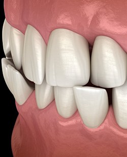 a 3D illustration of a crossbite