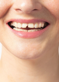 Woman with a broken tooth