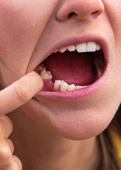 Woman missing a tooth