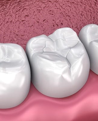 tooth-colored fillings