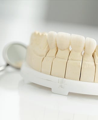 bridges on example teeth