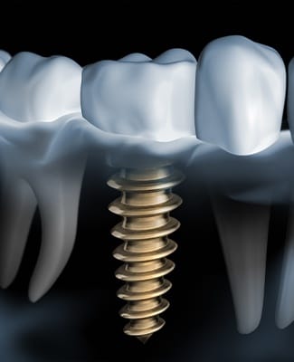 illustration of implant