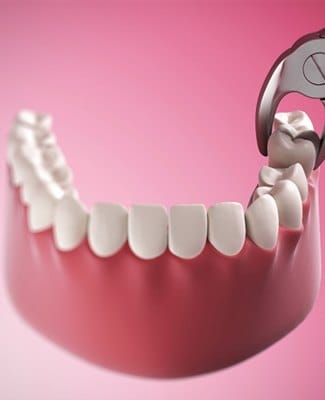 model of tooth extraction