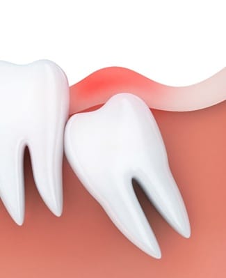 impacted wisdom tooth