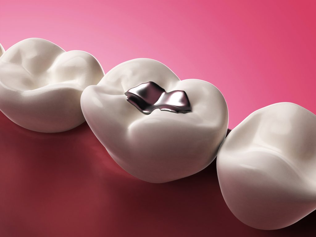 3D illustration of a silver tooth filling on a molar Drew Beaty DDS