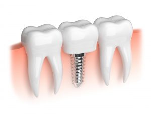  An illustration of dental implants.