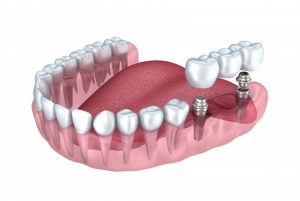 dental implants abutments and bridge