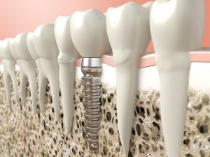 model of dental implant