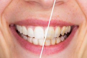 A comparison of a woman’s smile “before” and “after” teeth whitening