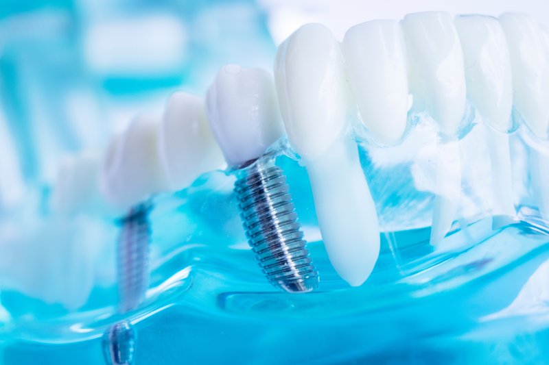 a model example of dental implants in Federal Way