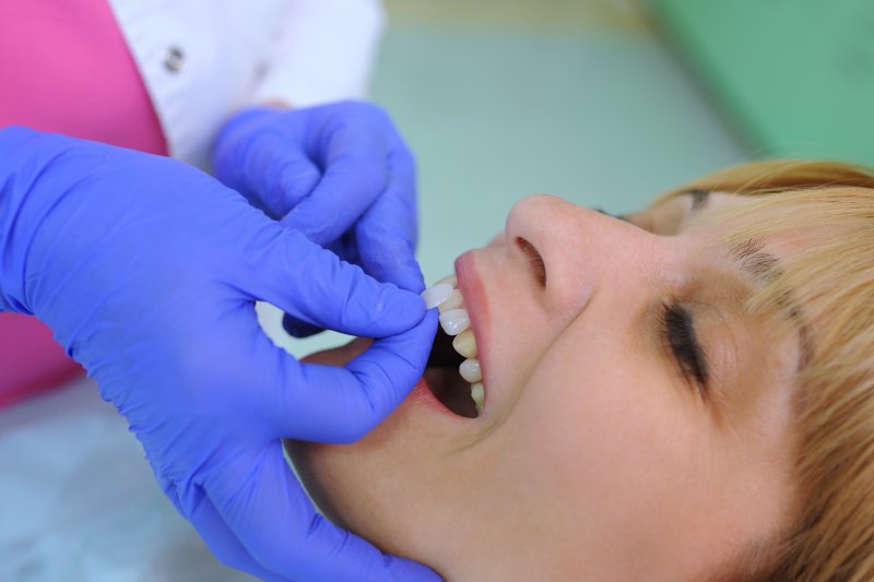 patients having their veneers applied